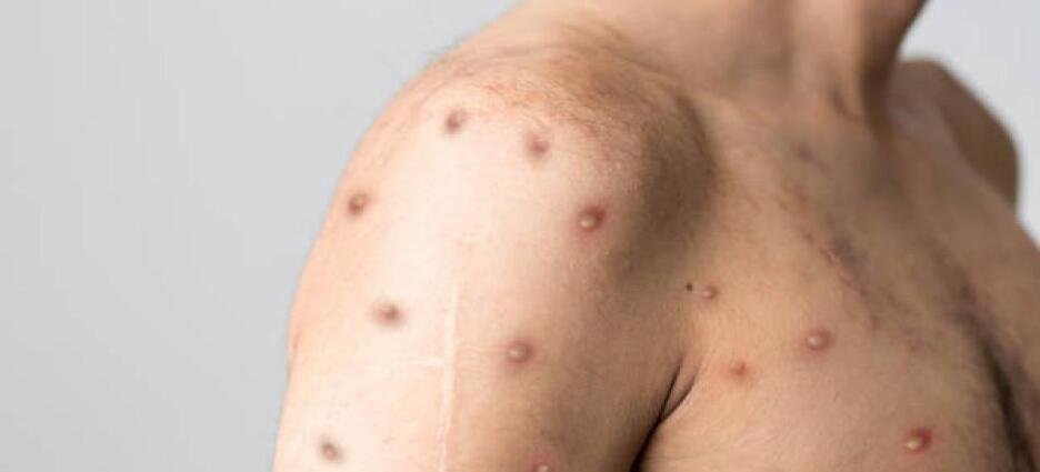 El secretario de salud confirma nuevo caso positivo de viruela del mono