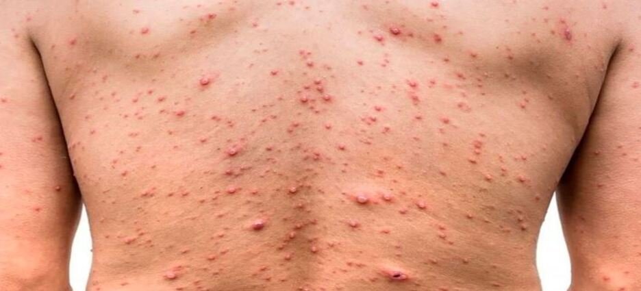 Cuatro casos bajo sospecha de Viruela del mono en el estado