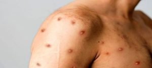 Confirmado segundo paciente con viruela del mono en el estado