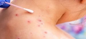 Aislan a menores por sospecha de Viruela del mono