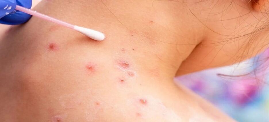 Aislan a menores por sospecha de Viruela del mono