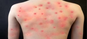 Hay un cuarto sospechoso de contagio de Viruela del mono en el estado