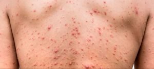 Detectan 3 casos sospechosos de Sinaloa