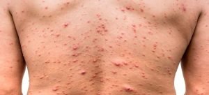 Sinaloa llega a los 14 casos positivos de viruela del mono