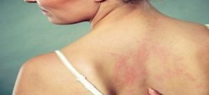 Sinaloa tiene 10 casos de lepra activos