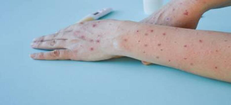 Sinaloa registra la primera muerte por Viruela del mono