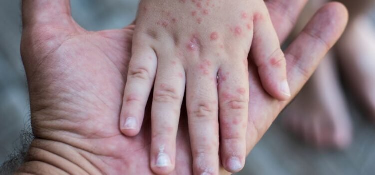 Piden declarar alerta epidemiológica en Sinaloa, ante brote de sarampión